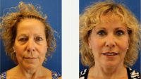 71 Year Old Woman Treated With Facelift Before By Dr. Stanley P. Gulin, MD, Naples Plastic Surgeon