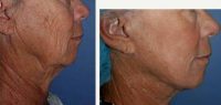 71 Year Old Woman Treated With Facelift Before With Dr Christopher T. Maloney Jr., MD, Tucson Plastic Surgeon