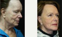72 Year Old Woman Treated With Facelift Before By Dr. Kris M. Reddy, MD, FACS, West Palm Beach Plastic Surgeon