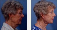 75 And Up Year Old Woman Treated With Facelift Before By Dr Jan Zemplenyi, MD, Bellevue Facial Plastic Surgeon
