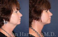 55-64 year old woman treated with Facelift and Neck Liposuction