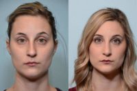 26 year old woman treated with Rhinoplasty with Chin Implant