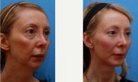 Doctor Frank P. Fechner, MD, Worcester Facial Plastic Surgeon - Lady Underwent A Facelift