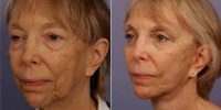 Doctor Grant Stevens, MD, Los Angeles Plastic Surgeon - 69 Year Old Woman Treated With Facelift