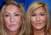 Doctor Hannah Vargas, MD, Kansas City Facial Plastic Surgeon - Mid-Face Lift