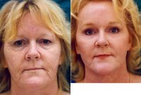 Doctor Juris Bunkis, MD, FACS, Newport Beach Plastic Surgeon - 54 Year Old Woman Treated With Facelift