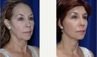 Doctor Kamran Khoobehi, MD, New Orleans Plastic Surgeon - 73 Year Old Woman Treated With Facelift