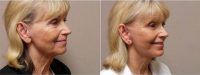 Doctor Shahriar Mabourakh, MD, FACS, Sacramento Plastic Surgeon - 64 Year Old Woman Treated With Facelift