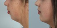 18-24 year old woman treated with surgical chin augmentation
