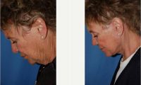 Doctor William Portuese, MD, Seattle Facial Plastic Surgeon - 72 Year Old Woman Treated With Facelift