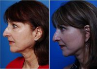 Dr Anurag Agarwal, MD, Naples Facial Plastic Surgeon - 60 Year Old Woman Who Wanted Improvement Of Her Neck, Jowls And Lower Eyelids