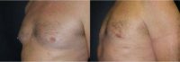45-54 year old man treated with Male Breast Reduction