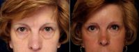 Dr Douglas L. Gervais, MD, Minneapolis Plastic Surgeon - 64 Year Old Woman Wanted To Look Younger