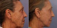 Dr Grant Stevens, MD, Los Angeles Plastic Surgeon - 66 Year Old Woman Treated With Facelift