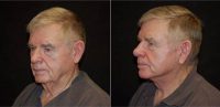 Dr Jeffrey D. Wagner, MD, Indianapolis Plastic Surgeon - 73 Year Old Man Treated With Facelift