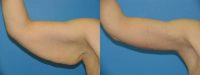 40 yr old woman with an arm lift