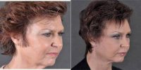 Dr Richard J. Bruneteau, MD, Omaha Plastic Surgeon - 48 Year Old Woman Treated With Facelift, Brow Lift, Upper And Lower Eyelids