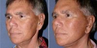 Dr Ritu Chopra, MD, Beverly Hills Plastic Surgeon - 73 Year Old Man Treated With Facelift