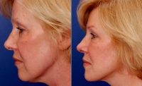 Dr Stephen Weber, MD, FACS, Denver Facial Plastic Surgeon - 60 Year Old Woman Treated With Facelift Before