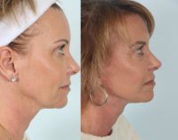 55-64 year old woman treated with Facelift and Platysmal Myectomy