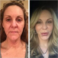Dr. Brenda Schiesel, DO, Tulsa Board Certified Plastic Surgeon Facial Face Lift