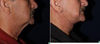 Dr. Christopher T. Maloney Jr., MD, Tucson Plastic Surgeon - 63 Yar Old Male Face Lift