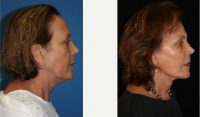 Dr. John Layke, DO, FACS, Beverly Hills Plastic Surgeon - 70 Year Old Woman Treated With Facelift