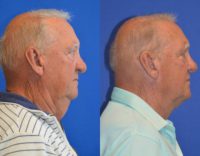 65-74 year old man treated with Neck Lift
