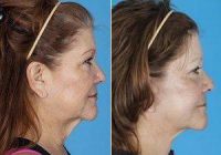 Dr. Jose E. Barrera, MD, FACS, San Antonio Facial Plastic Surgeon - 58 Yo Female Treated For Facial Aging And Sagging Neck
