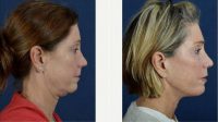 Dr. Michael M. Kim, MD, Portland Facial Plastic Surgeon - 64 Year Old Woman Treated With Facelift