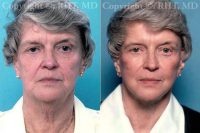 Dr. Richard H. Tholen, MD, FACS, Minneapolis Plastic Surgeon - 68 Yo Woman Requesting Facial Rejuvenation After First Facelift 15 Years Ago (elsewhere). Before