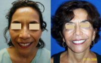 Face And Neck Lift Surgery Before With Doctor Tom J. Pousti, MD, FACS, San Diego Plastic Surgeon