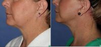Face Lift, 56 Year Old Before With Dr. Christopher T. Maloney Jr., MD, Tucson Plastic Surgeon