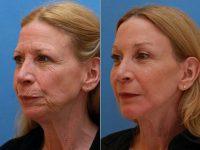 Facelift And Facial Fat Injections Before With Dr Frank P. Fechner, MD, Worcester Facial Plastic Surgeon