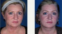 Facelift Before By Doctor Edward J. Ricciardelli, MD, Wilmington Plastic Surgeon