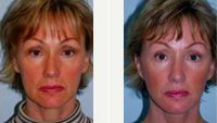 Facelift Before By Dr Joanne Lopes, MD, Virginia Beach Plastic Surgeon