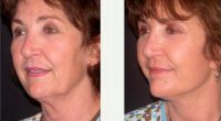 Facelift Before By Dr. Thomas Fiala, MD, Orlando Plastic Surgeon