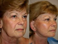 Facelift With SMASectomy Before By Dr. Jeffrey M. Darrow, MD, Boston Plastic Surgeon