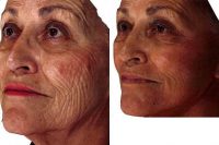 Female Facelift And Laser Resurfacing Before With Dr Farhan Taghizadeh, MD, Phoenix Facial Plastic Surgeon