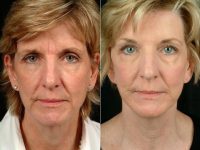 Mini-Facelift, Injectable Filler  Laser Before With Dr. Ben Hugo, MD, Virginia Beach Plastic Surgeon