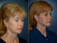 Revision Facelift Before With Dr. Richard P. Rand, MD, FACS, Seattle Plastic Surgeon
