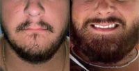 25-34 year old man treated with FUE Hair Transplant, NeoGraft, Beard Transplant