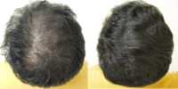 25-34 year old man treated with Hair Loss Treatment