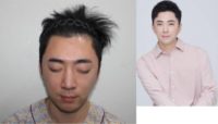 25-34 year old man treated with FUE Hair Transplant, Hair Transplant