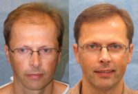 45-54 year old man treated with Hair Loss Treatment