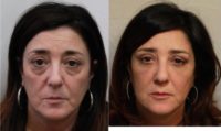 45-54 year old woman treated with Eye Bags Treatment and fat transfer