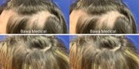 45-54 year old woman treated with Hair Loss Treatment, PRP for Hair Loss, PRP Injections, Microneedling