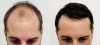 18-24 year old man treated with Hair Transplant