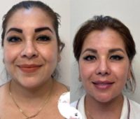 35-44 year old woman treated with Deep Plane Facelift