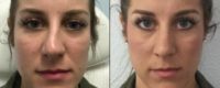 25-34 year old female Liquid Nose Job with Injectable Fillers